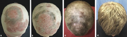 Hair growth