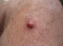 skin cancer