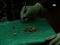 mumbai-doctors-remove-232-teeth-from-teens-mouth