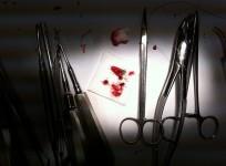 tooth extraction
