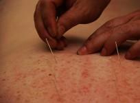 acupuncture