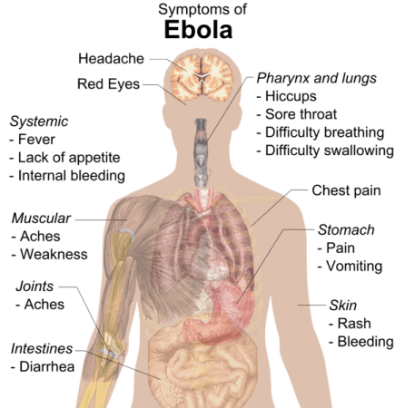 The symptoms of Ebola Hemorrhagic Fever. Ebola Symptoms