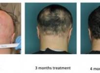 Alopecia areata