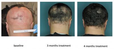 Alopecia areata