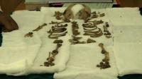 india-doctors-remove-foetus-left-inside-mother-for-36-years