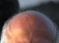 bald