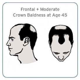 In the study, men with moderate baldness at the front and crown of the head at age 45, had 40 percent increased risk of developing an aggressive form of prostate cancer than men without the hair loss condition. bald