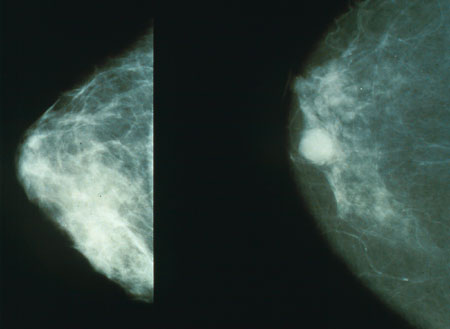 Virtual Breast