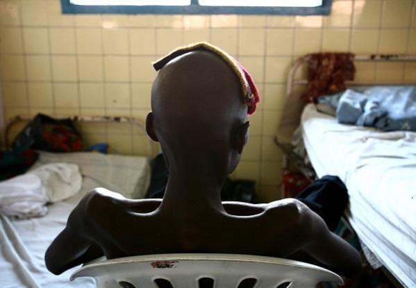A man suffering from AIDS sits on a chair at the state general hospital in Congo's capital of Kinshasa. A new study has found that HIV began its global spread in the 1920s in Kinshasa in Democratic Republic of Congo (DRC). A man suffering from AIDS sits on a chair at the state general hospital in Congo's capital of Kinshasa.A new study has found that HIV began its global spread in the 1920s in Kinshasa in Democratic Republic of Congo (DRC).