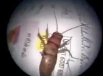 Doctor Pulls Out Three-inch Insect Alive from Ear Canal
