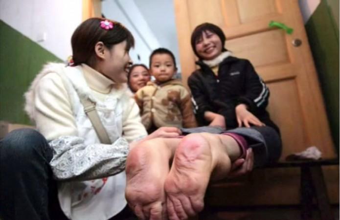 Woman Born with Backward Feet Claims to Run Faster Than Her Friends Miraculous Woman! Born with Backward Feet Claims to Run Faster Than Her Friends