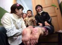 Miraculous Woman! Born with Backward Feet Claims to Run Faster Than Her Friends