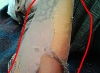 ISIS used chemical weapon against Kurdish fighters