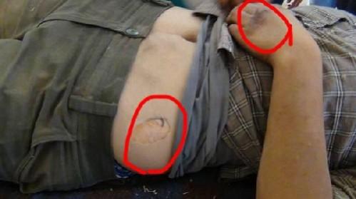 ISIS used chemical weapon against Kurdish fighters ISIS used chemical weapon against Kurdish fighters
