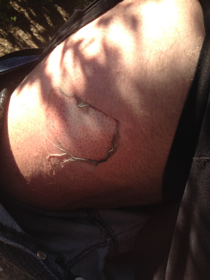 Philip's leg after the accident iPhone 6 caught fire