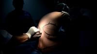 colombias-post-weight-loss-patients-find-help-in-surgery