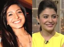 Celebs Before and After Cosmetic Surgery in Pictures