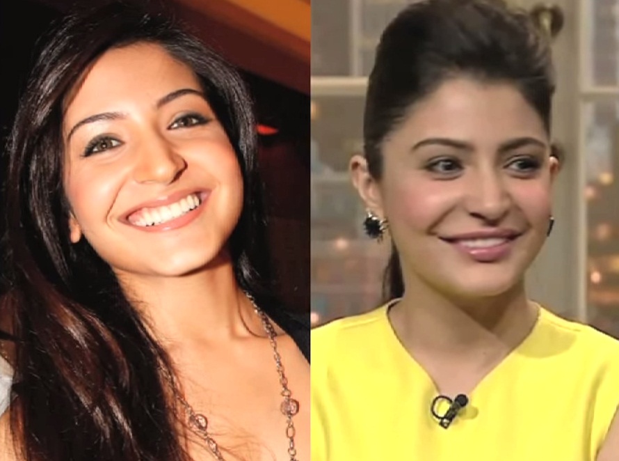 Before & After: Anushka Sharma Celebs Before and After Cosmetic Surgery in Pictures