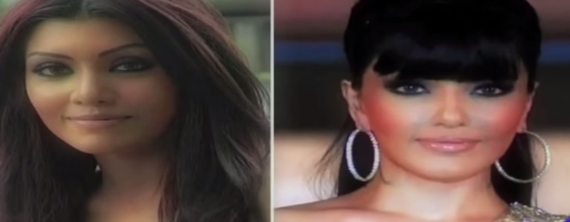 Celebs Before and After Cosmetic Surgery in Pictures