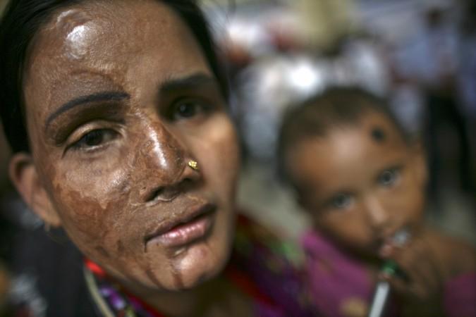 Acid attack