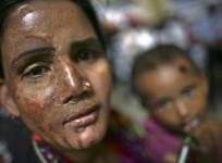 Acid attack