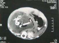 'fetus in fetu' condition wherein babies are born pregnant