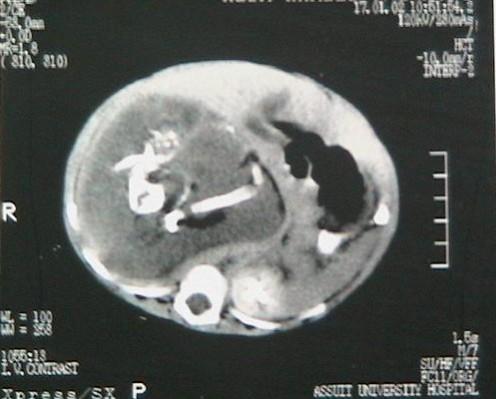 Computed Tomography scan of the patient, suffering from the 'fetus in fetu'. 'fetus in fetu' condition wherein babies are born pregnant