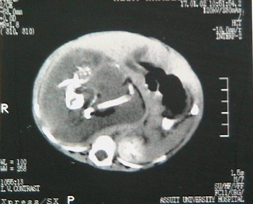 'fetus in fetu' condition wherein babies are born pregnant