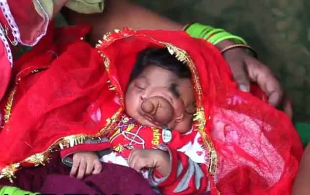 Baby girl born with trunk-like growth between her eyes is worshipped by villagers in Aligarh, Uttar Pradesh