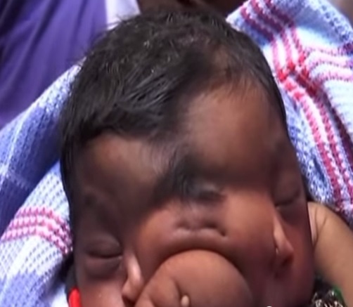 Baby girl born with trunk-like growth between her eyes is worshipped by villagers in Aligarh, Uttar Pradesh