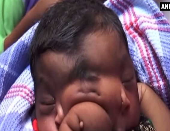 Baby girl born with trunk-like growth between her eyes is worshipped by villagers in Aligarh, Uttar Pradesh