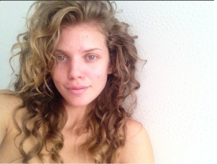 Annalynn McCord with pimples Annalynn McCord with pimples