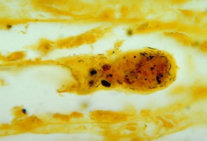 Leptospirosis