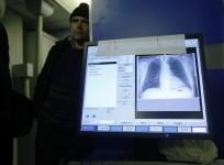tuberculosis