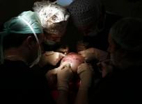 hair transplant