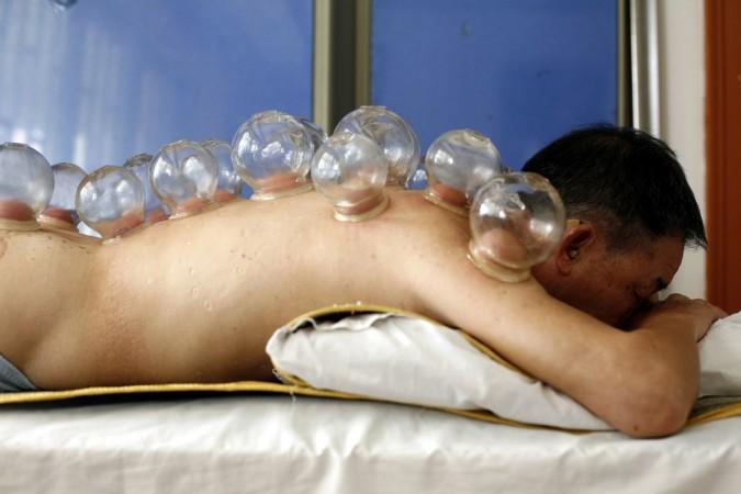 cupping