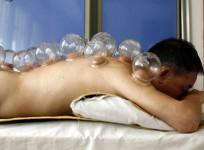 cupping