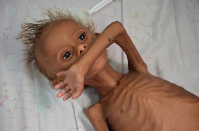 A malnourished boy lies on a bed at a hospital in the Red Sea port city of Houdieda, Yemen, September 9, 2016. children yemen