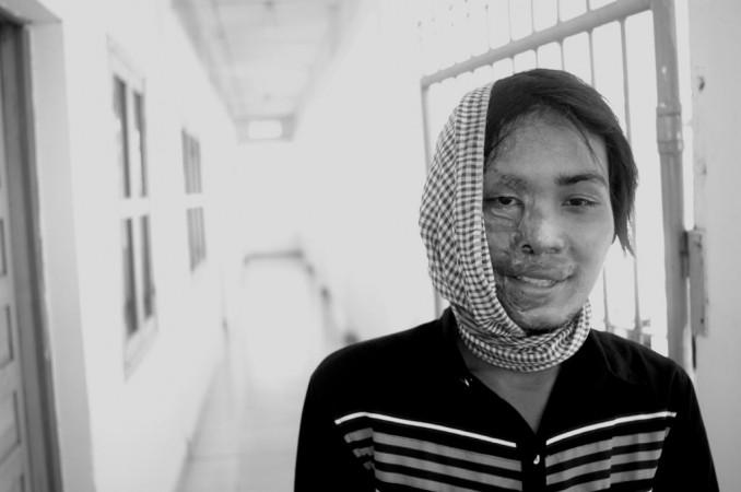 acid attack, acid attack survivor,