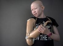 Tanzanias ghost people: Putting an end to albino persecution