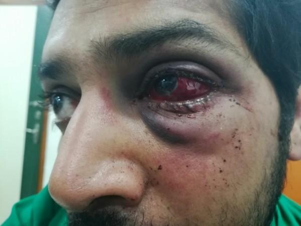 Dr. Rohan Mamunkar has lost vision in one eye Dr. Rohan Mamunkar