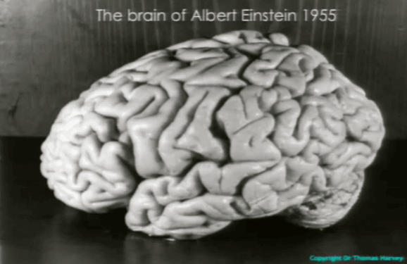 Albert Einstein's brain Albert Einstein's brain
