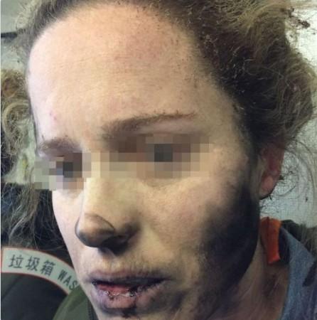 Headphone explosion burns Headphone explosion burns