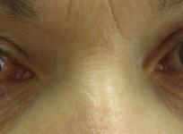glaucoma, eyes, glaucoma week 2017, health,