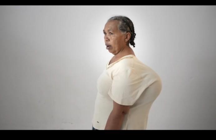The lump was initially noticed by Mariette when she was in her 20s, by the time she reached her 60s, the tumour had grown enormously, turning 20 inches bigger and weighing 10 lbs (approximately 4.5 kilograms)! tumor, Madagascar, woman, Mercy Ships, health,