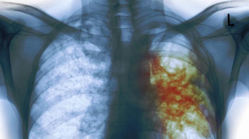 March 24 is celebrated as World Tuberculosis Day, a rise in the number of youth suffering from TB has been observed in the city of Mumbai, India. World Tuberculosis Day 2017, TB, youth, Mumbai, India,