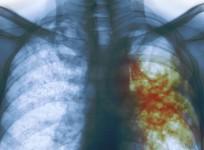 World Tuberculosis Day 2017, TB, youth, Mumbai, India,