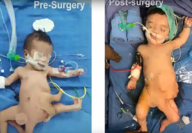 The Iraqi baby boy, named Karam, suffered from a rare condition called polymelia, also known as hydra syndrome. In Greek, the term 'polymelia' stands for -- many limbs. Iraqi baby, polymelia, health, rare condition, genetic, baby, hydra syndrome,