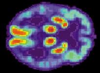drugs, Neurodegenerative brain disorders, Alzheimer's, Parkinson's,