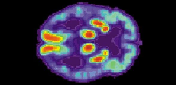 Researchers found two drugs that could slow down the progression of neurodegenerative diseases like Alzheimer's and Parkinson's. drugs, Neurodegenerative brain disorders, Alzheimer's, Parkinson's,